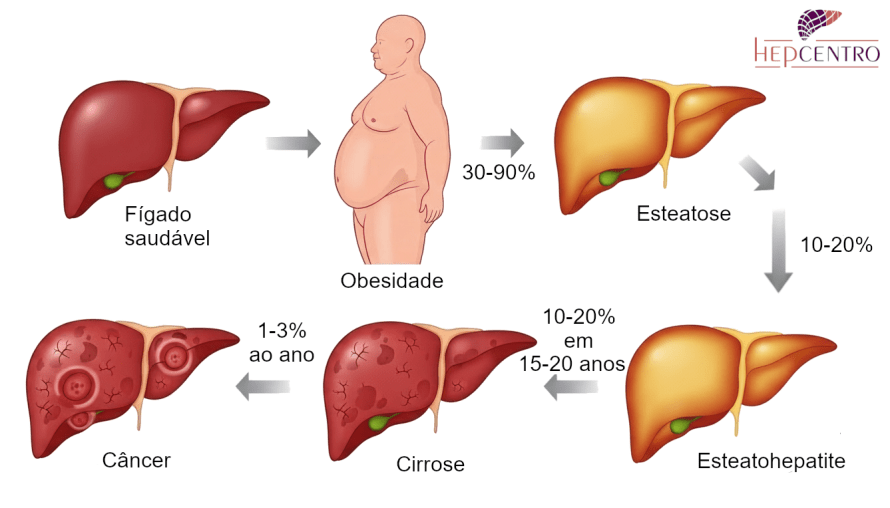 Dieta Essencial para Reverter a Gordura no Fígado: O Guia Completo