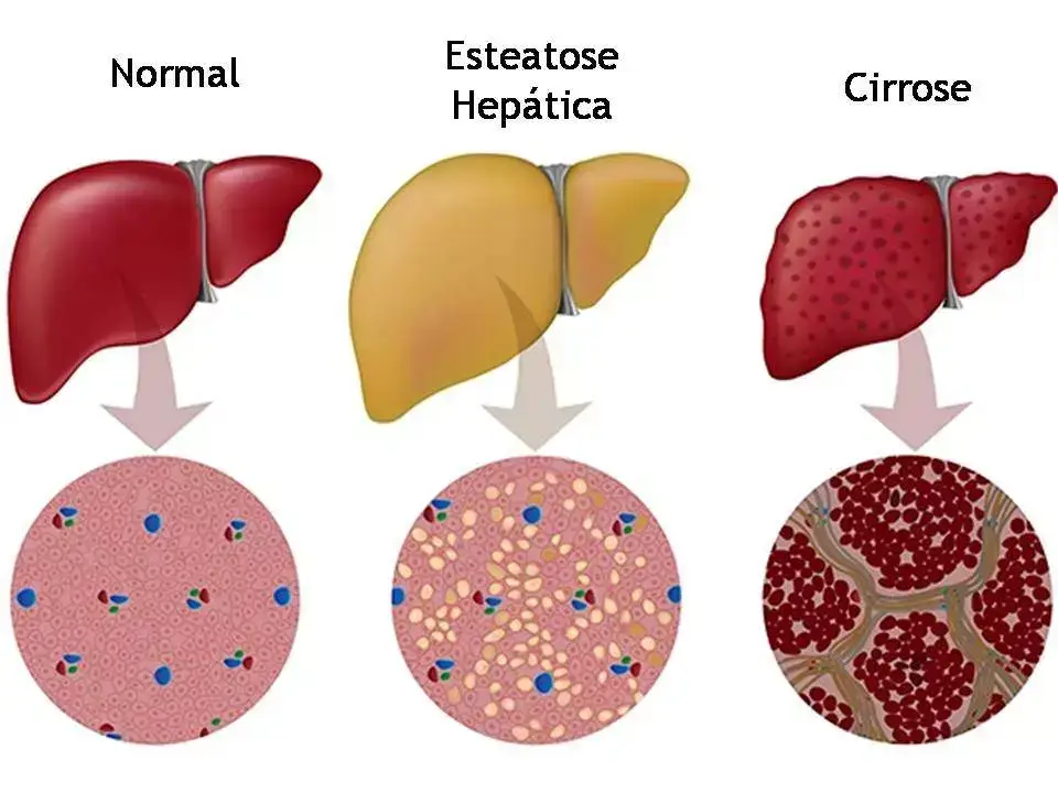 Curcumina e Ozempic: Novas Perspectivas no Tratamento da Esteatose Hepática
