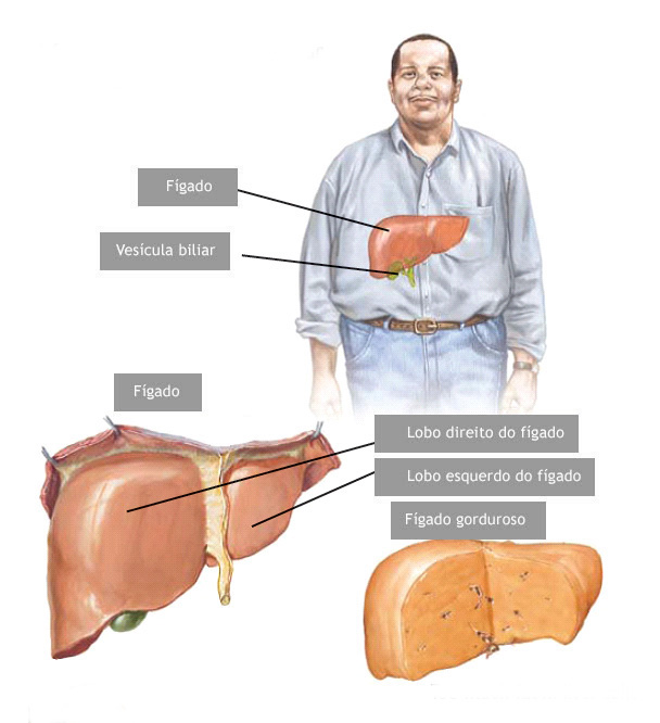 Como Prevenir a Progressão da Esteatose Hepática para Cirrose