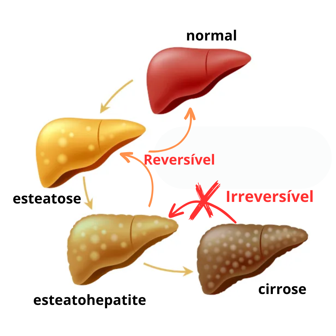 esteatose hepática