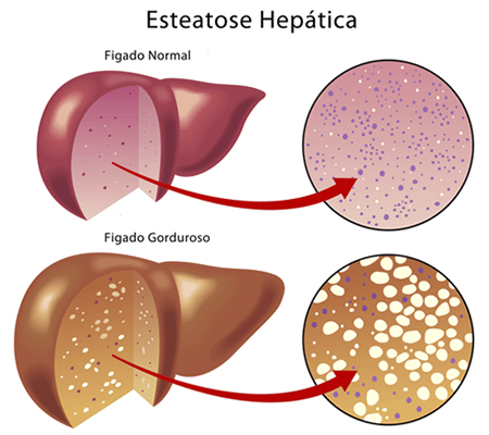 Esteatose Hepática Alcoólica vs. Não Alcoólica: Entenda as Diferenças e Tratamentos