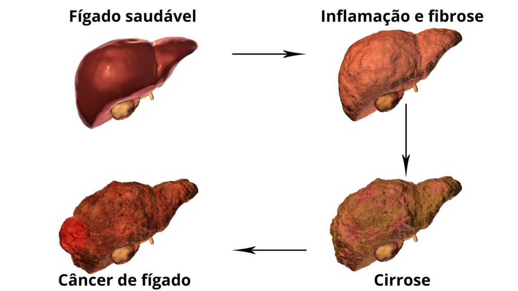 Os Sinais Silenciosos da Gordura no Fígado que Você Não Pode Ignorar