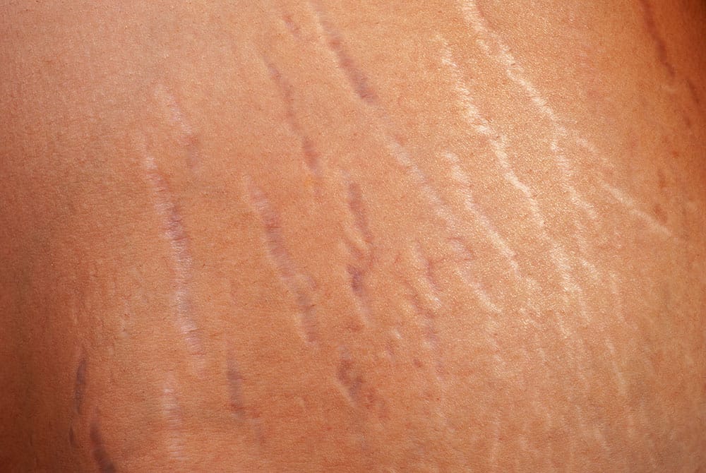 como eliminar estrias brancas