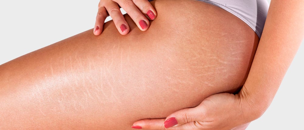 como eliminar estrias brancas