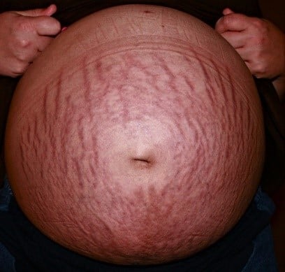 tratamento para estrias vermelhas profundas