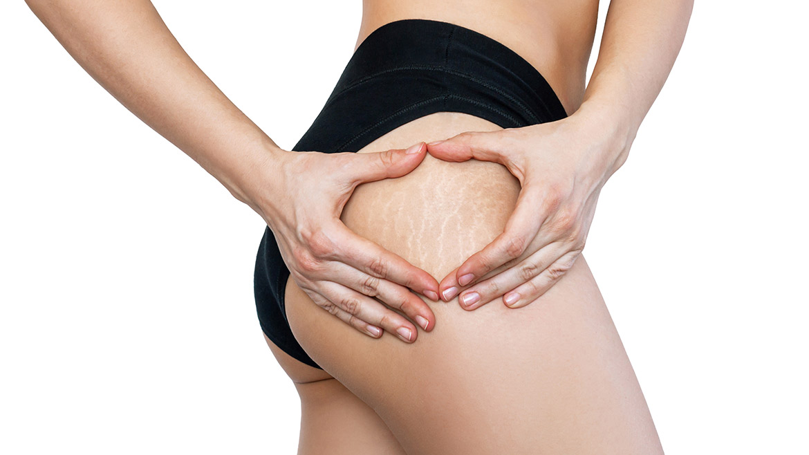 tratamento para estrias vermelhas profundas