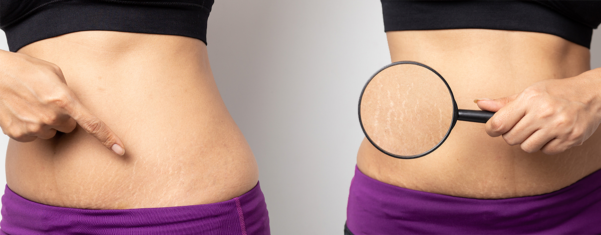 tratamento para estrias vermelhas profundas