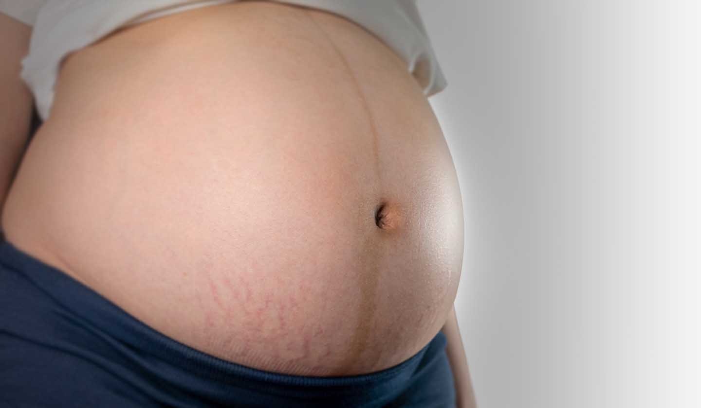 prevenção de estrias na gravidez