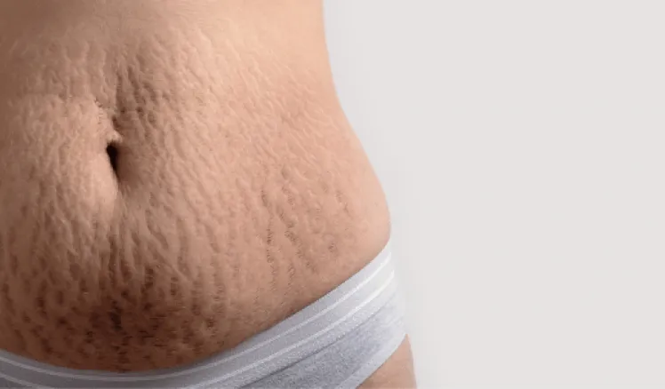 prevenção de estrias na gravidez