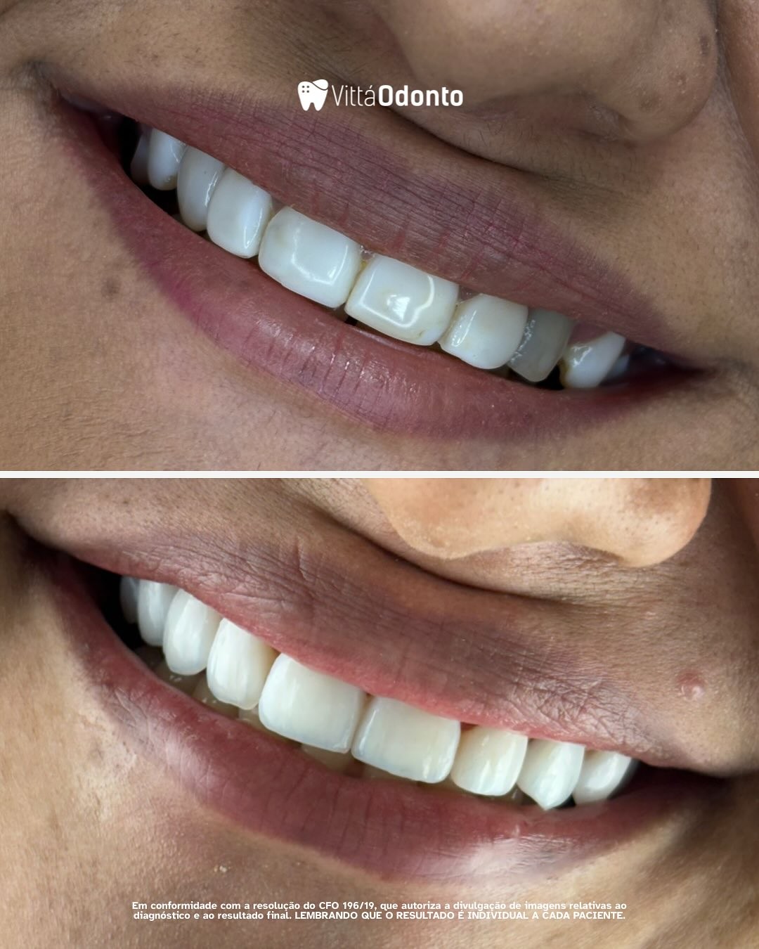 facetas de porcelana e implantes dentarios qual a melhor opcao para voce