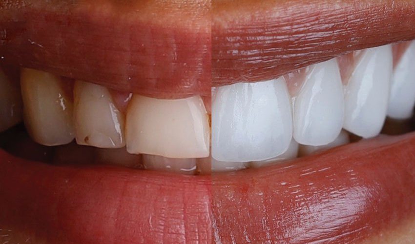 Mitos e Verdades sobre Facetas Dentárias