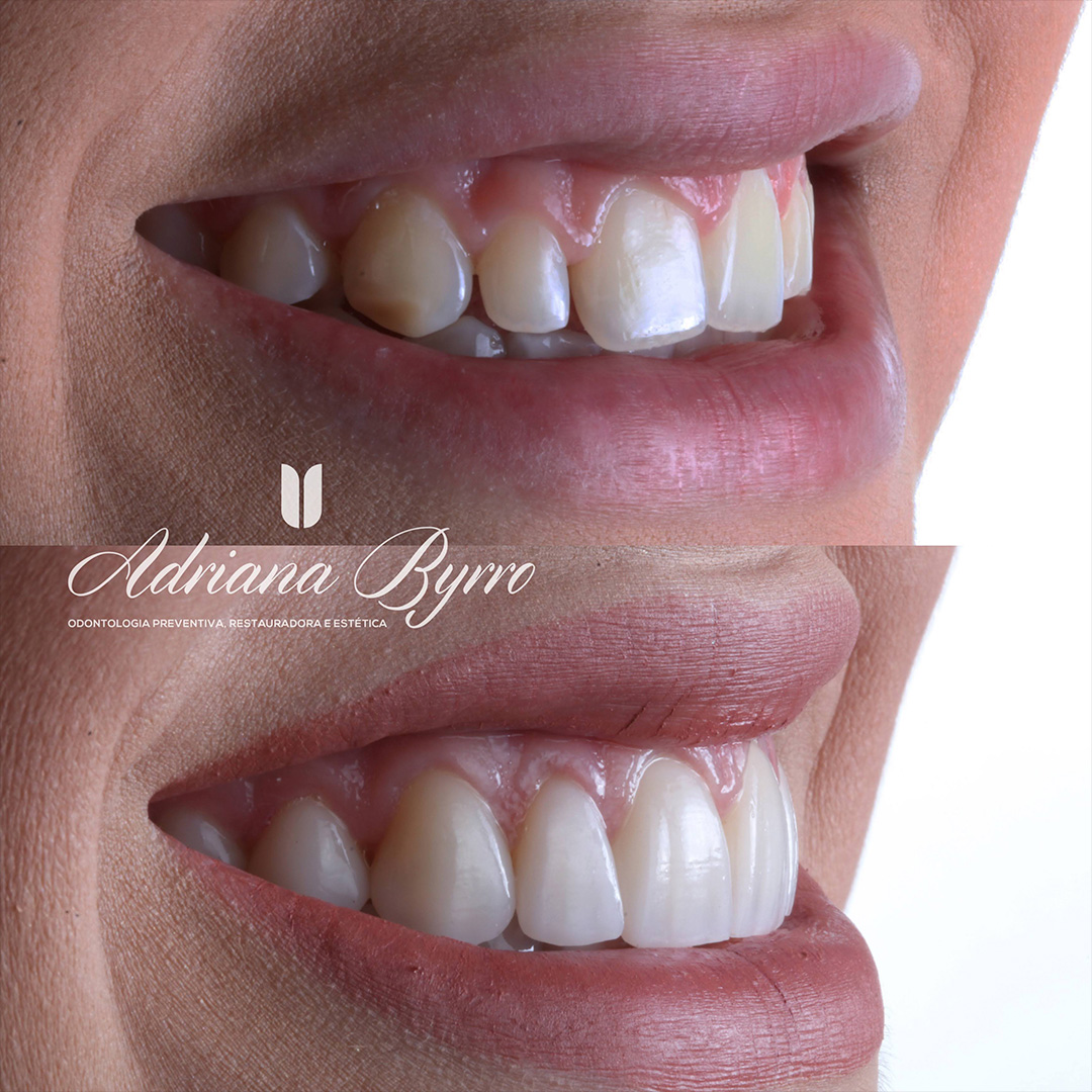 Quando Optar por Implantes Dentários: Sinais de que é a Hora Certa