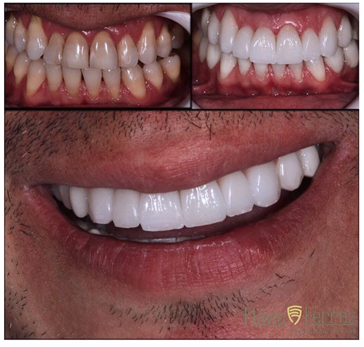 facetas de porcelana e implantes dentarios qual a melhor opcao para voce