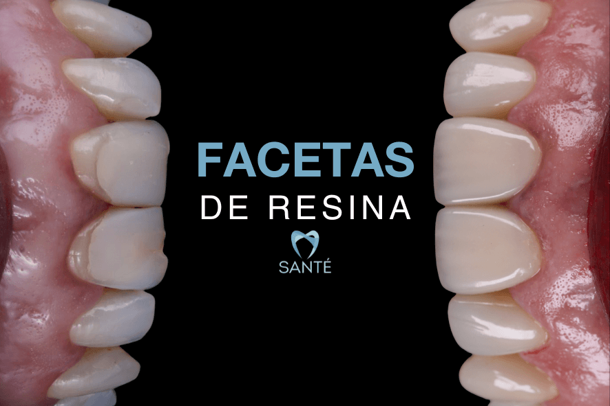 Cuidados Essenciais Pós-Colocação de Facetas de Porcelana