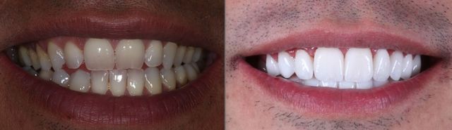 Coroas de Porcelana: A Solução Intermediária para Seu Sorriso