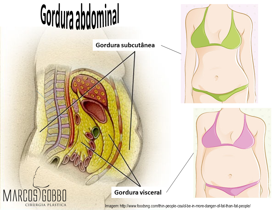 gordura abdominal