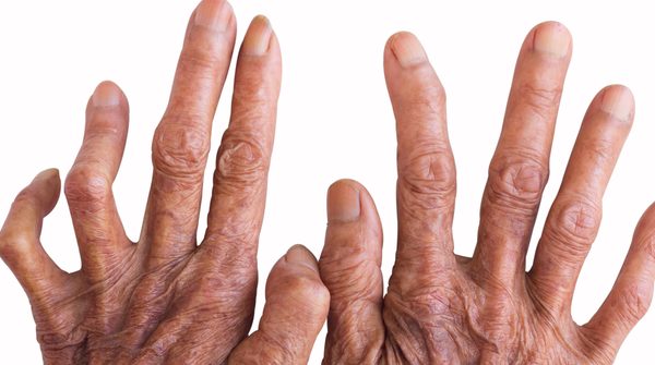 Onde encontrar suporte nutricional gratuito para Hanseníase no SUS