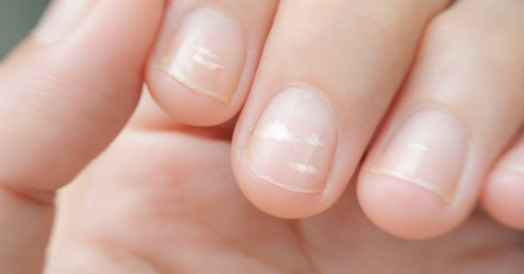 7 dicas para evitar manchas brancas nas unhas