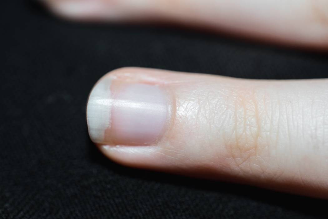 o que não fazer quando a unha tem mancha branca