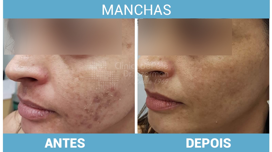 Melasma: Causas