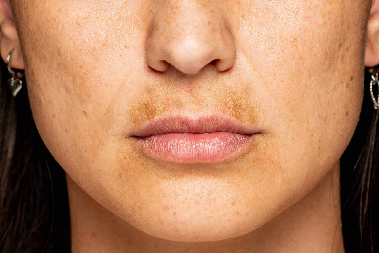 Melasma: Causas