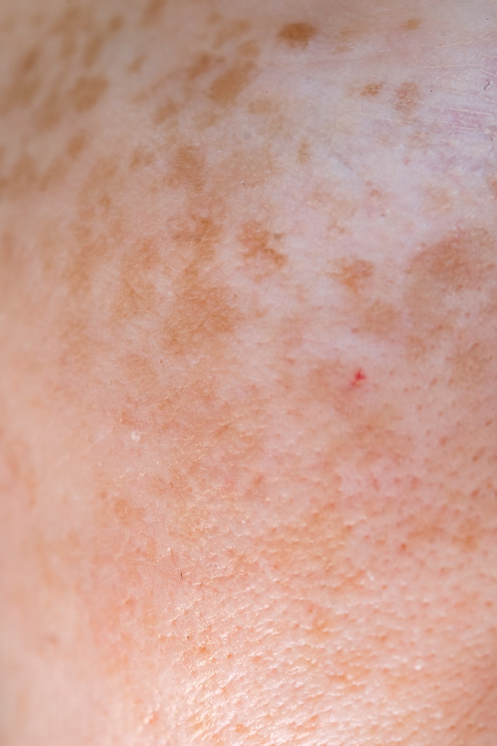 Manchas Brancas na Pele: Vitiligo