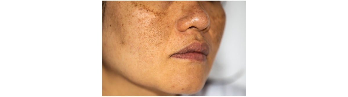 Como Escolher o Protetor Solar Ideal para Prevenir Manchas na Pele