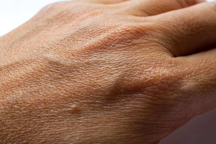 tratamento para mãos ásperas e ressecadas