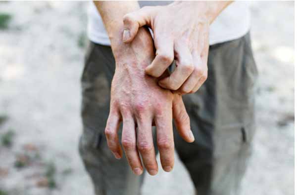 melhores cremes para mãos com dermatite