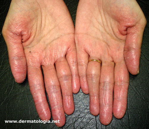 tratamento para mãos ásperas e ressecadas