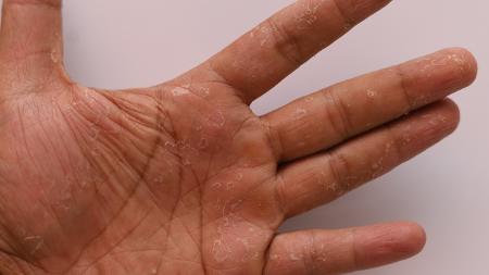 melhores cremes para mãos com dermatite