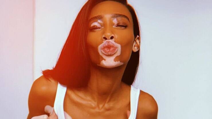 Como o vitiligo afeta a saúde mental feminina