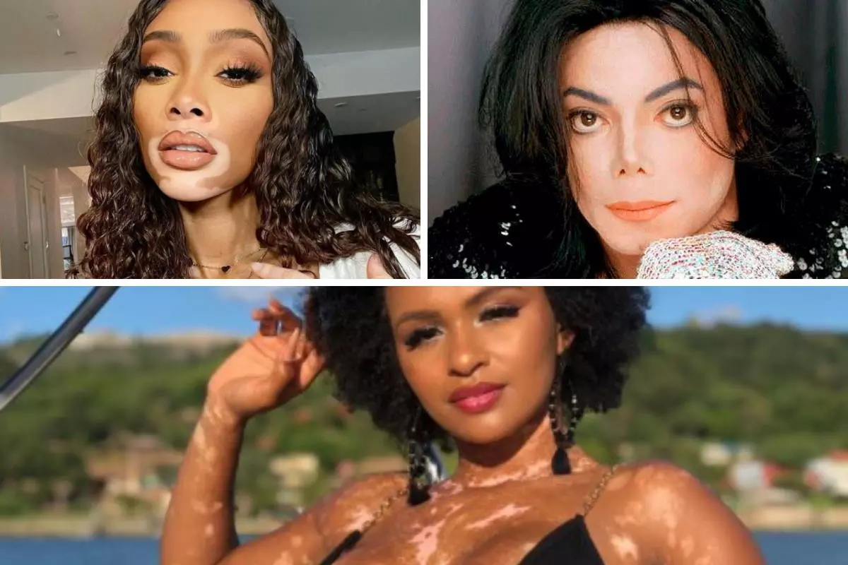 O papel da suplementação no tratamento do vitiligo