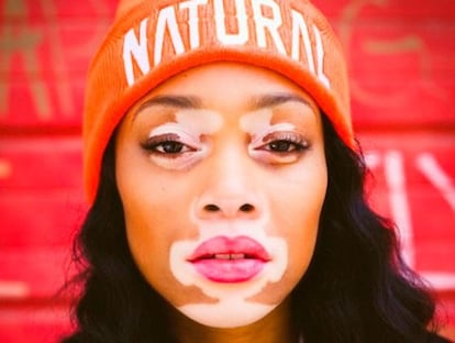 Vitiligo: Mitos e verdades sobre tratamentos