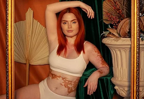 Dicas de maquiagem para vitiligo: Arte e camuflagem