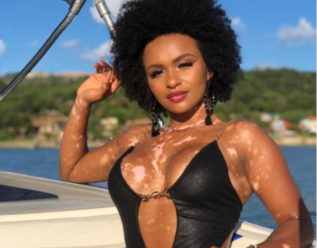 Como o vitiligo afeta a saúde mental feminina