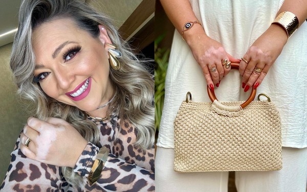 Vitiligo: Mitos e verdades sobre tratamentos