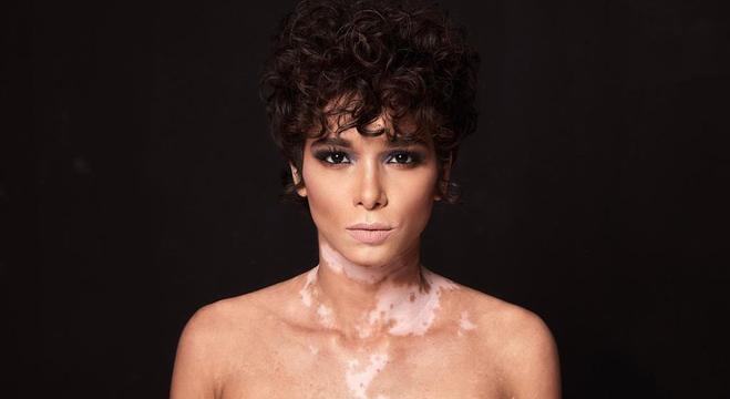 Dicas de maquiagem para vitiligo: Arte e camuflagem