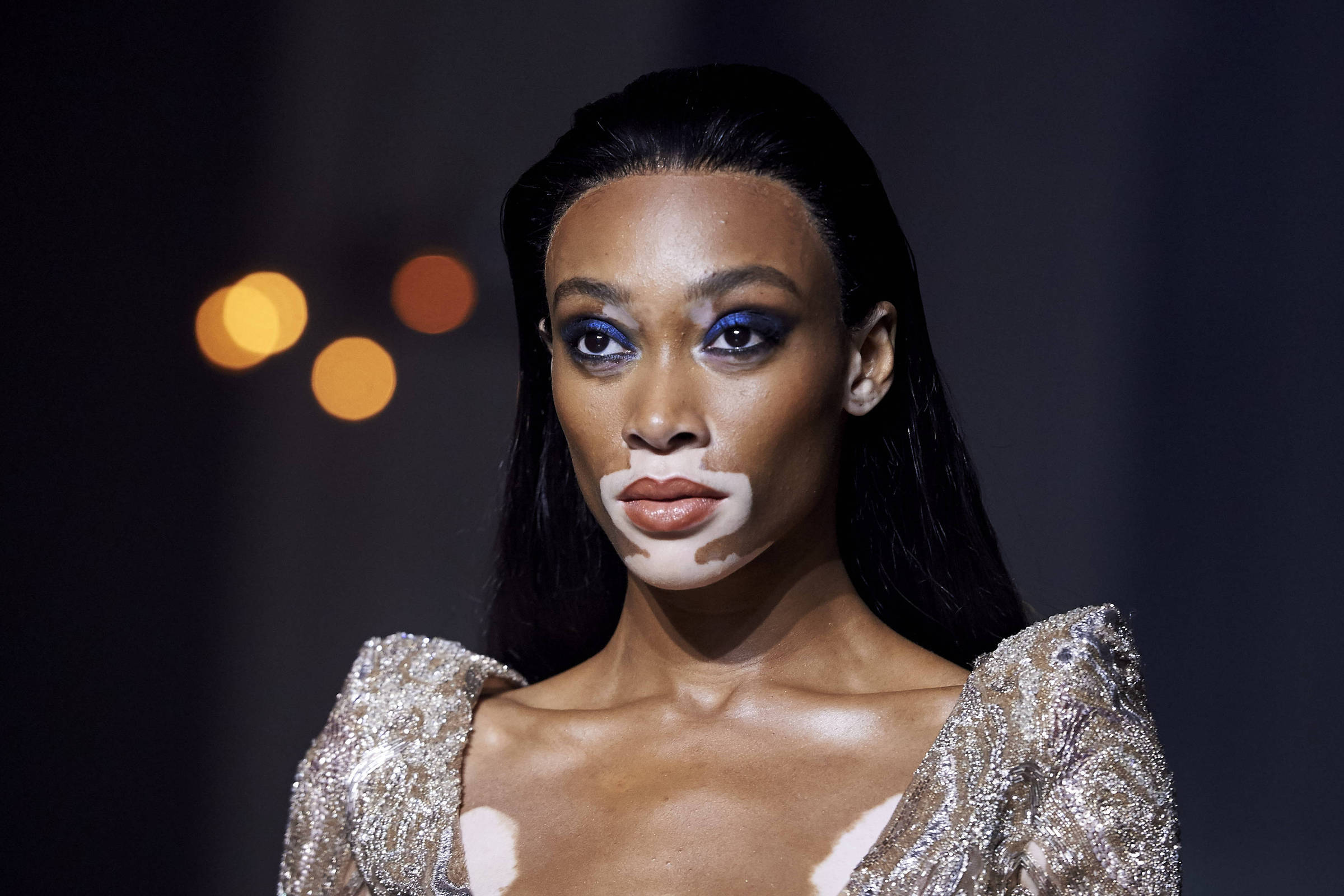 Como o vitiligo afeta a saúde mental feminina