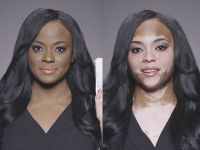 Vitiligo: Mitos e verdades sobre tratamentos