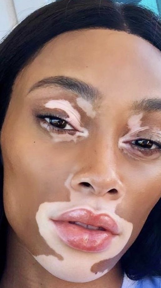 A importância da representatividade do vitiligo na mídia