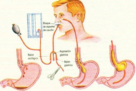 Sondas de Gastrostomia e Jejunostomia: Tudo o que Você Precisa Saber