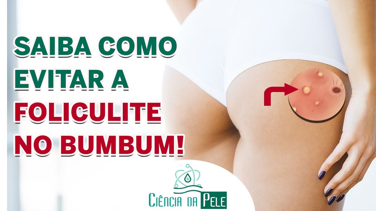 Diferença entre Foliculite e Acne: Saiba Identificar e Tratar Corretamente