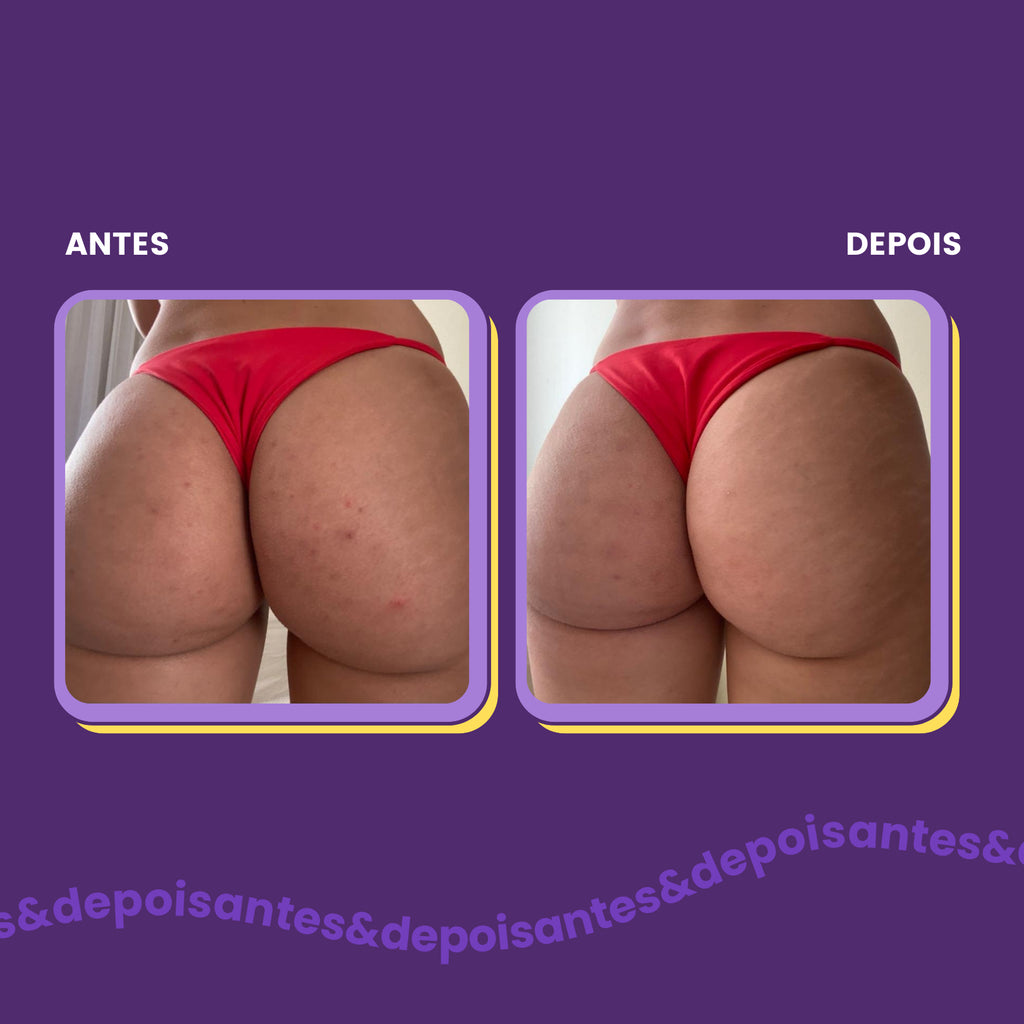 Foliculite Pós-Depilação: Dicas Essenciais para Evitar Pelos Encravados