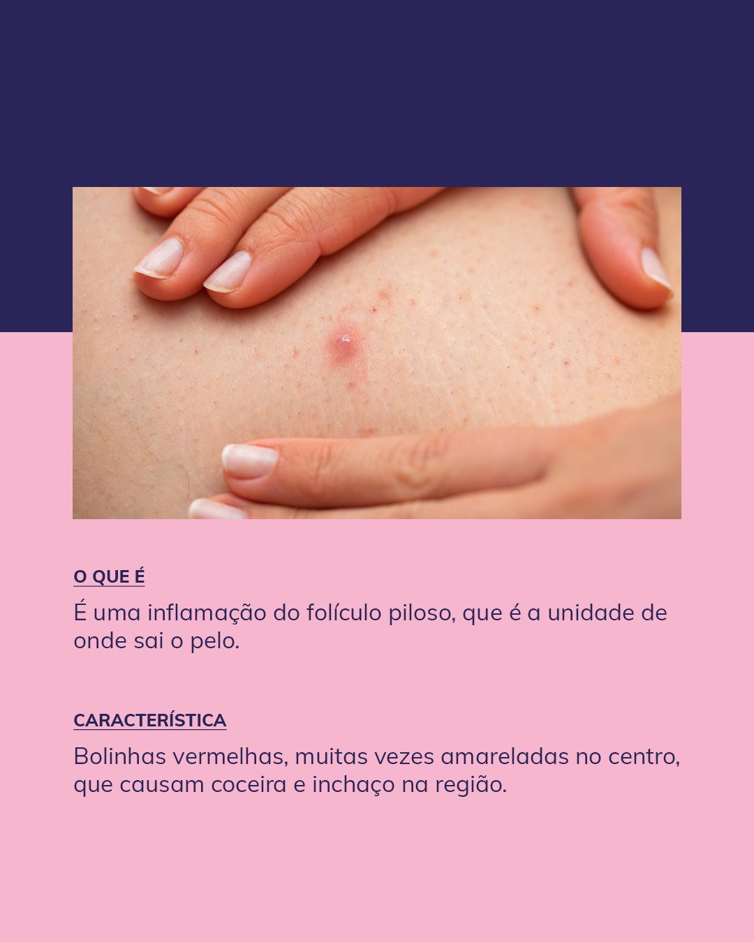 Diferença entre Foliculite e Acne: Saiba Identificar e Tratar Corretamente