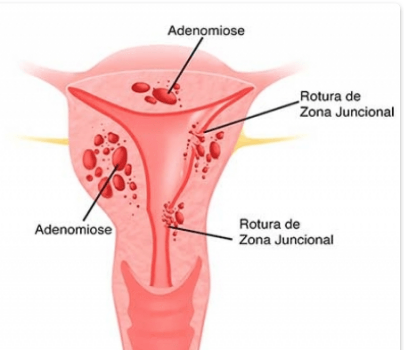 Adenomiose vs. Endometriose: Entenda as Diferenças e Semelhanças