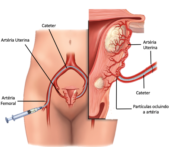 Adenomiose e Gravidez: Desafios e Possibilidades para Mulheres