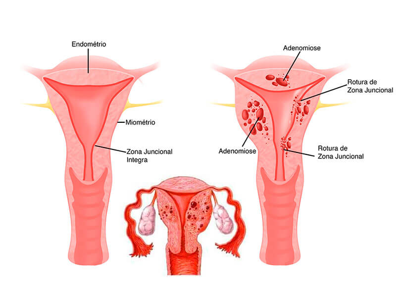 Adenomiose vs. Endometriose: Entenda as Diferenças e Semelhanças