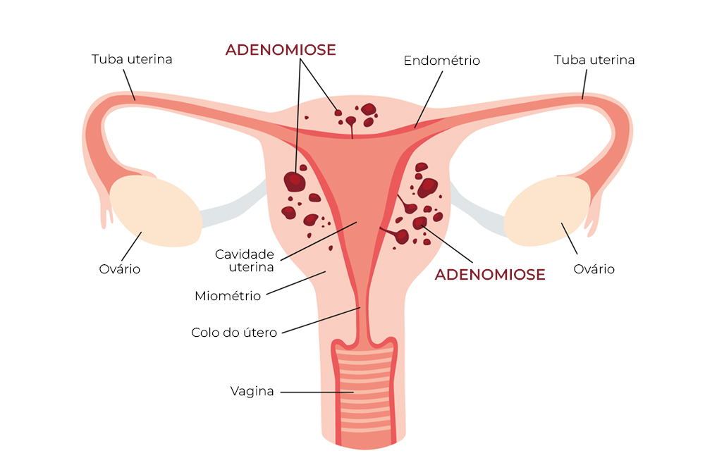 DIU Hormonal para Adenomiose: Uma Opção de Tratamento Eficaz?