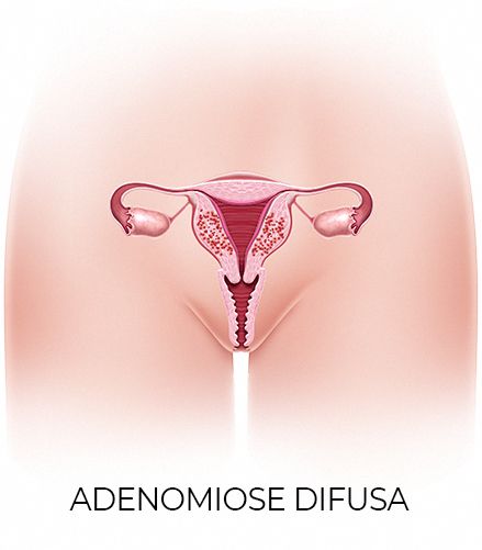 o que é adenomiose